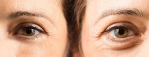 blepharoplastie laser