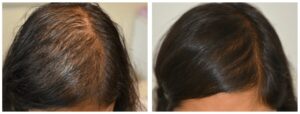 Greffe cheveux avant et après