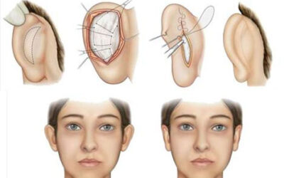 otoplastie enfant