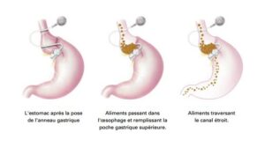 anneau gastrique Turquie