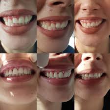 facettes dentaires Turquie