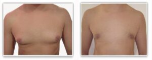 Gynecomastie Turquie prix