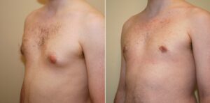 Gynecomastie Turquie