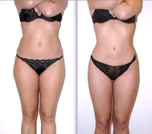 liposuccion laser Turquie