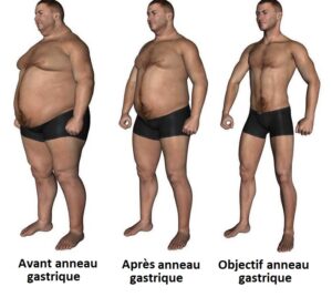 anneau gastrique Turquie
