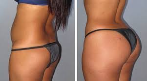 sculptra fesses Turquie prix