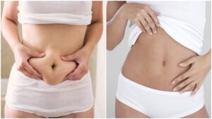 abdominoplastie Turquie