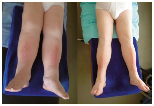 malformations lymphatiques
