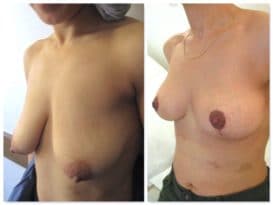lipofilling seins Turquie