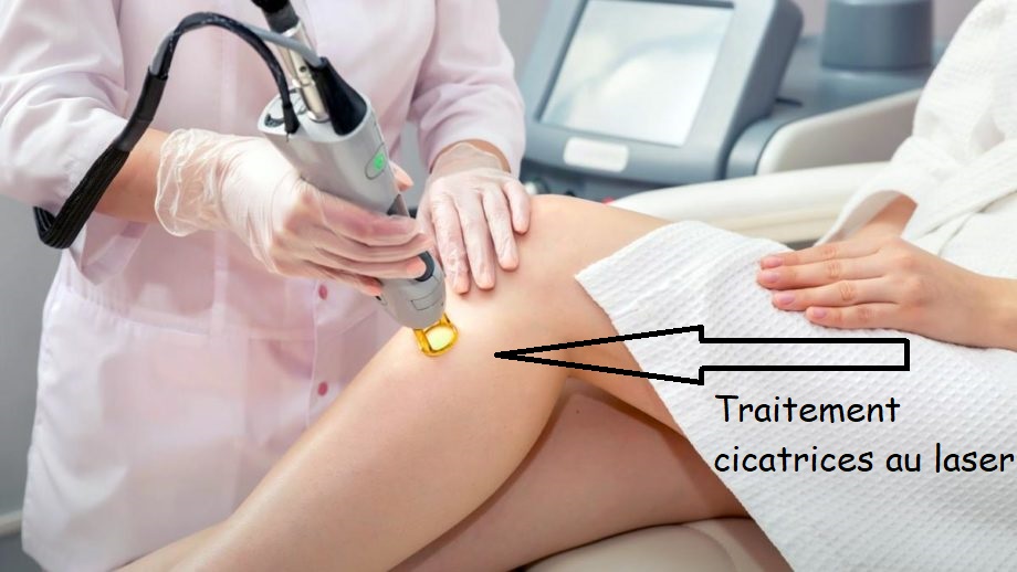 Traitement cicatrices au Laser