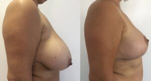 reduction mammaire Turquie