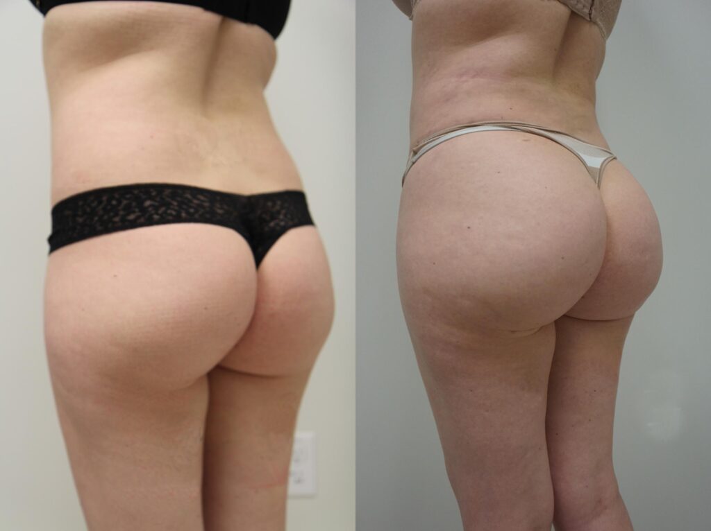 augmentation fesses