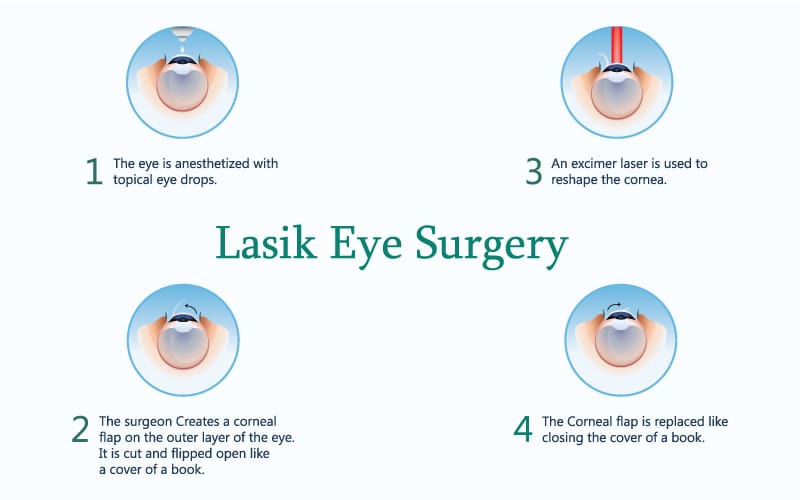 Lasik chirurgie astigmatisme