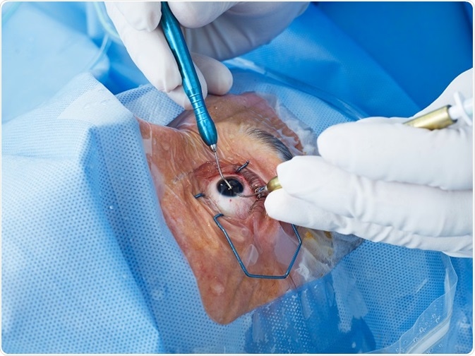 LIO : lentilles intraoculaires