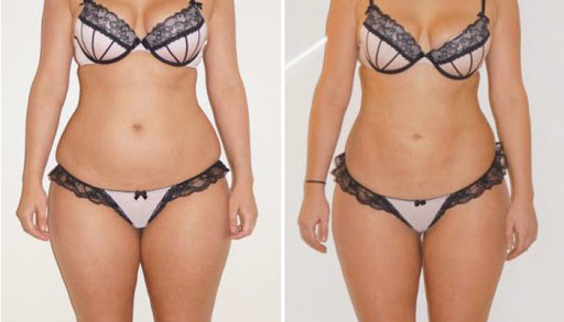 Quelles activités après une liposuccion ?