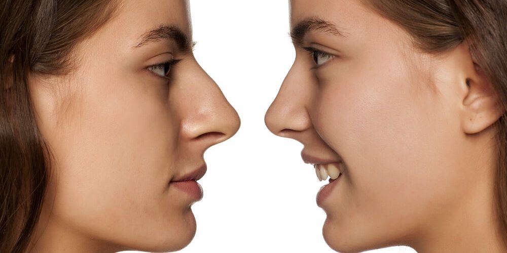 rhinoplastie secondaire