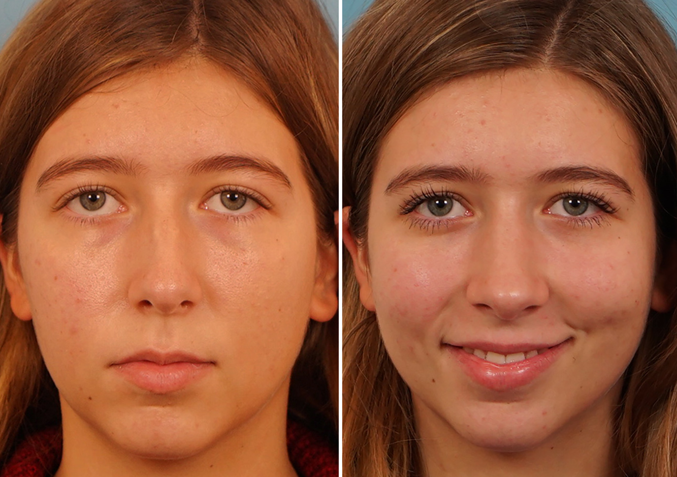 rhinoplastie ultrasonique
