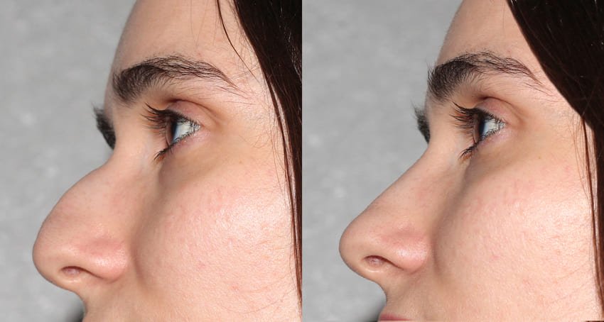 septo rhinoplastie Turquie