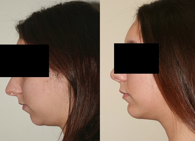 chirurgie esthétique menton Turquie