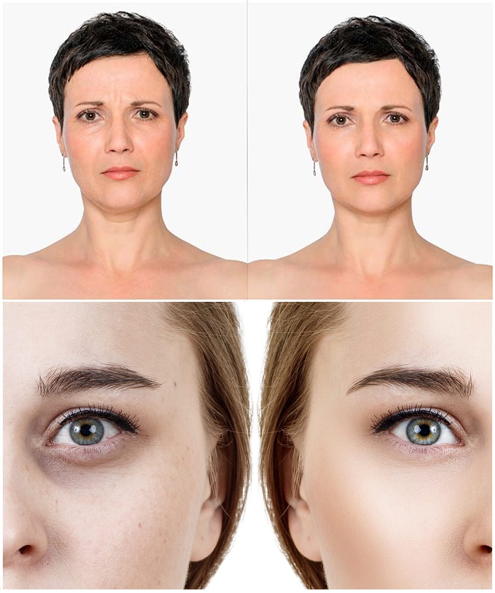 chirurgie esthétique paupières