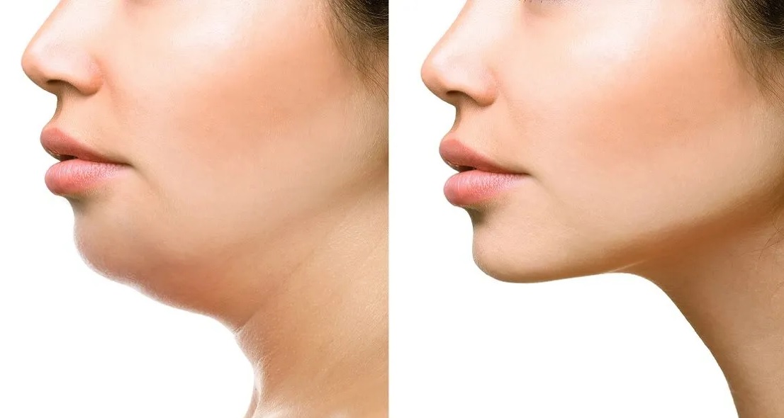 Chirurgie menton Turquie