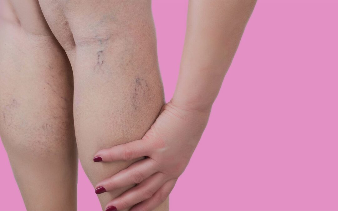 Laser vasculaire Turquie : Traitement des vaisseaux ou varicosités sans chirurgie